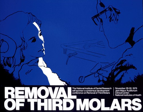 Removal of third molars (1979)