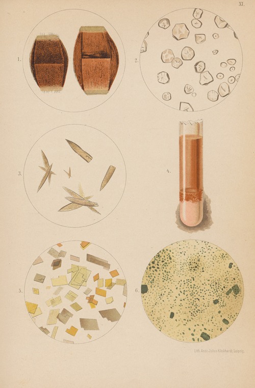 Uric Acid Crystals and Deposits
