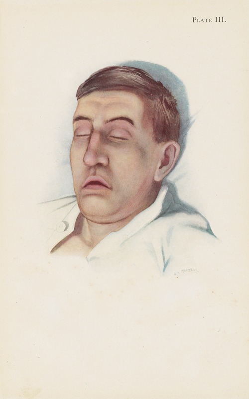 Plate III. Pallid type of asphyxia from phosgene poisoning, with circulatory failure