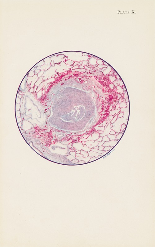 Plate X. Microscopic section of human lung from mustard gas poisoning, with death at end of second day (40 hours)