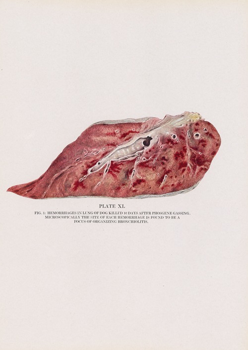 Plate XL (Fig. 1): Hemorrhages in lung of dog killed 10 days after phosgene gassing.