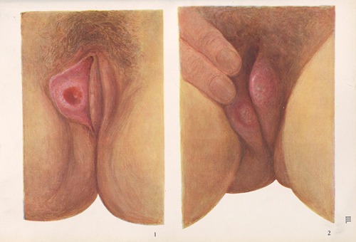 Venereal diseases – Syphilis Pl.03