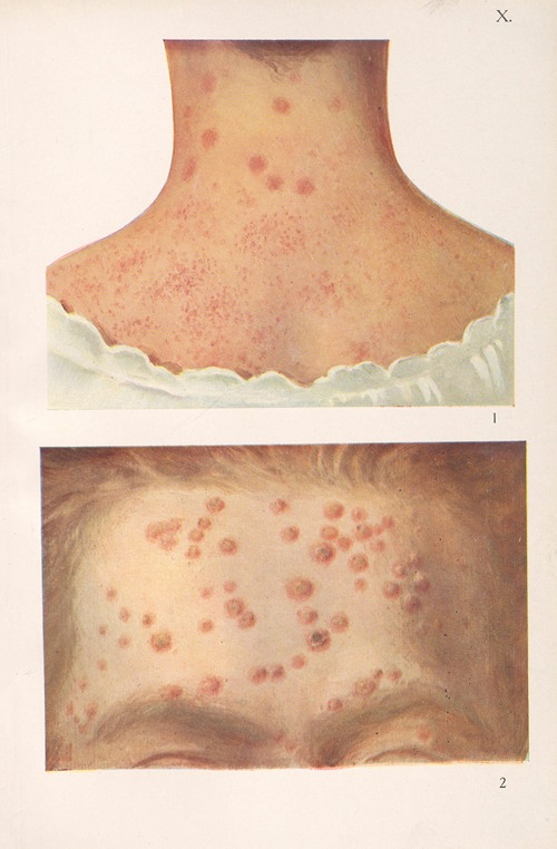 Venereal diseases – Syphilis Pl.10