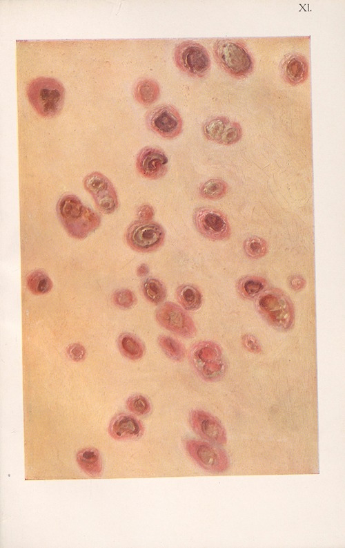 Venereal diseases – Syphilis Pl.11
