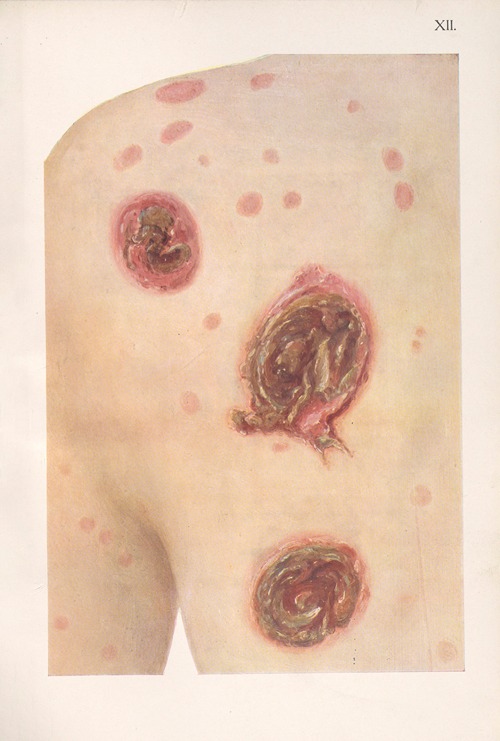 Venereal diseases – Syphilis Pl.12