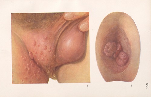Venereal diseases – Syphilis Pl.16