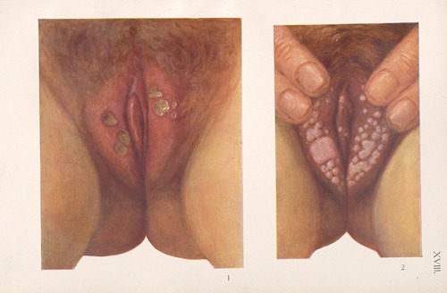 Venereal diseases – Syphilis Pl.18