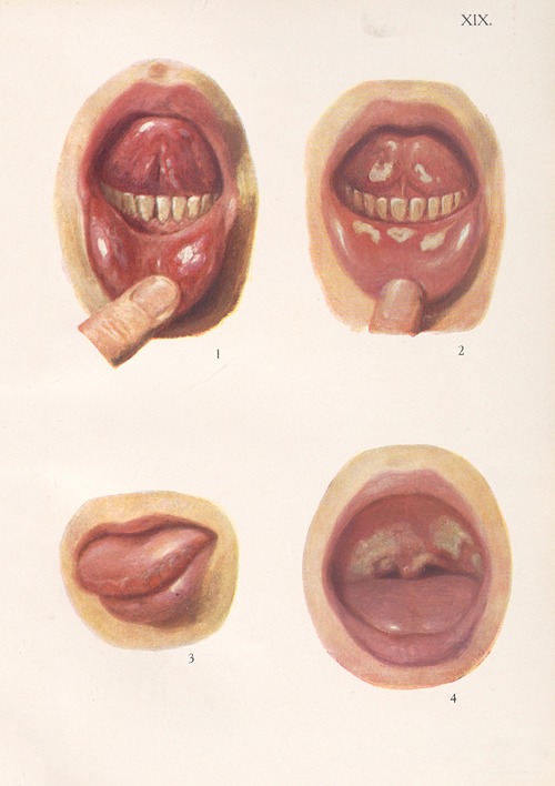 Venereal diseases – Syphilis Pl.19