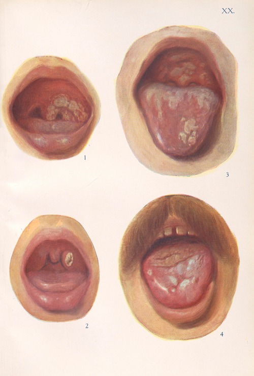 Venereal diseases – Syphilis Pl.20