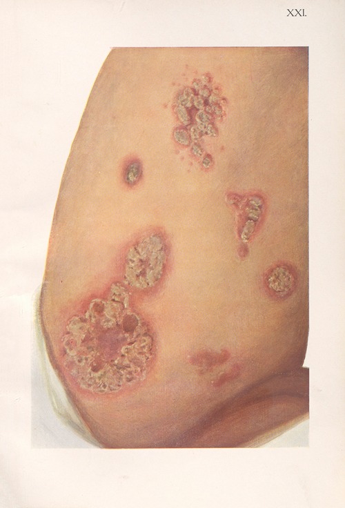 Venereal diseases – Syphilis Pl.21