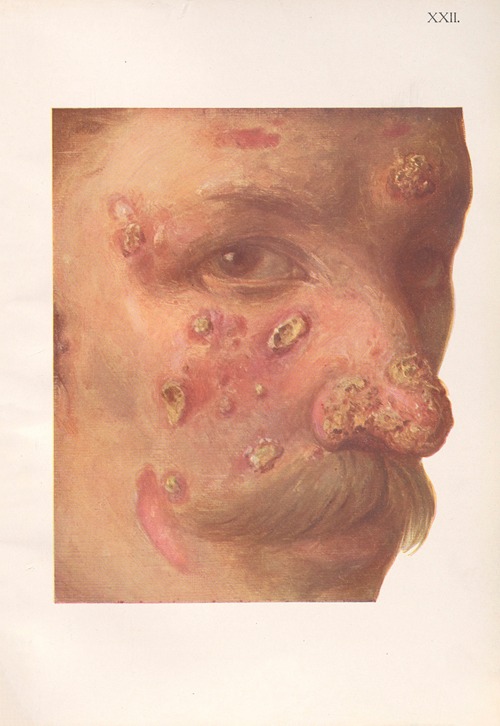 Venereal diseases – Syphilis Pl.22