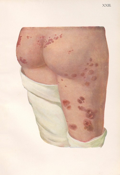 Venereal diseases – Syphilis Pl.23
