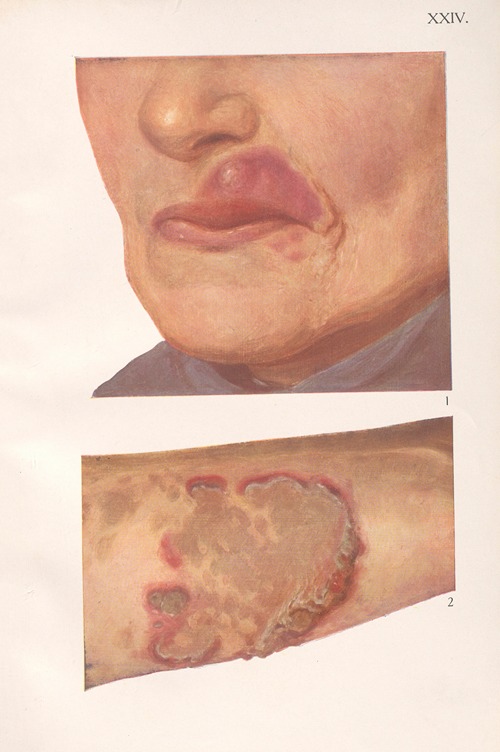 Venereal diseases – Syphilis Pl.24