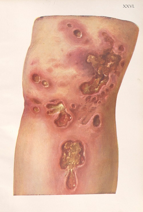 Venereal diseases – Syphilis Pl.26