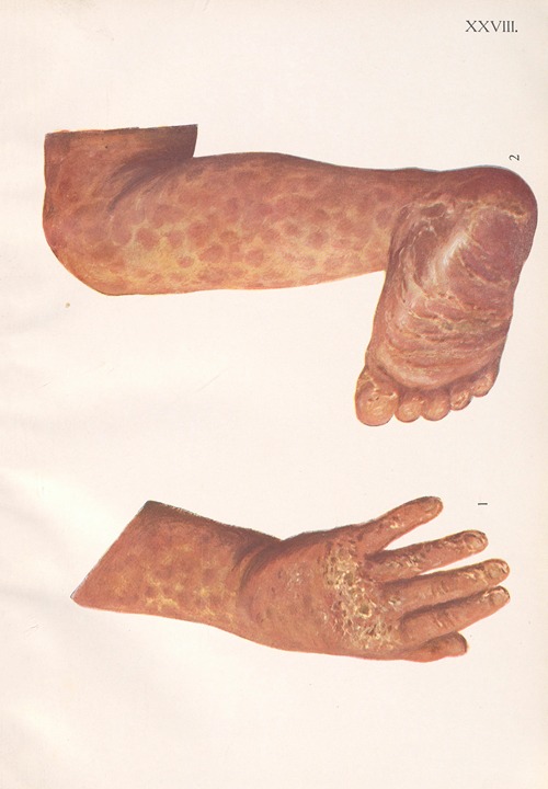 Venereal diseases – Syphilis Pl.28