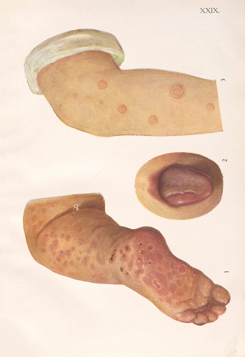 Venereal diseases – Syphilis Pl.29