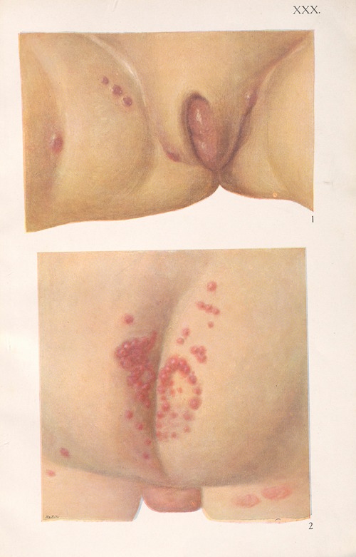 Venereal diseases – Syphilis Pl.30