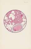 Plate I. Microscopic section of human lung from phosgene shell poisoning. Death at the nineteenth hour after gassing