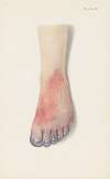 Plate IV. Gangrene of foot caused by vascular thrombosis from chlorine poisoning
