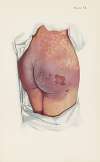 Plate VI. Blistering of buttocks by mustard gas