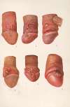 Venereal diseases – Syphilis Pl.01