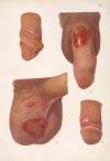 Venereal diseases – Syphilis Pl.02