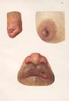 Venereal diseases – Syphilis Pl.04