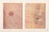 Venereal diseases – Syphilis Pl.06