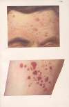 Venereal diseases – Syphilis Pl.08