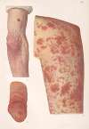 Venereal diseases – Syphilis Pl.09