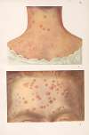 Venereal diseases – Syphilis Pl.10
