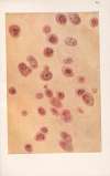 Venereal diseases – Syphilis Pl.11