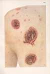 Venereal diseases – Syphilis Pl.12