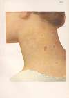 Venereal diseases – Syphilis Pl.14