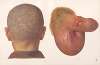 Venereal diseases – Syphilis Pl.15