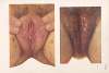 Venereal diseases – Syphilis Pl.17
