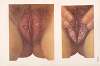 Venereal diseases – Syphilis Pl.18