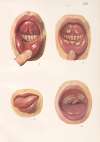 Venereal diseases – Syphilis Pl.19