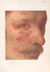 Venereal diseases – Syphilis Pl.22