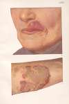 Venereal diseases – Syphilis Pl.24