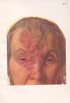Venereal diseases – Syphilis Pl.25