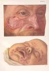 Venereal diseases – Syphilis Pl.27