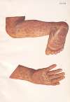 Venereal diseases – Syphilis Pl.28