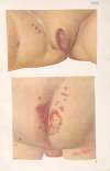 Venereal diseases – Syphilis Pl.30