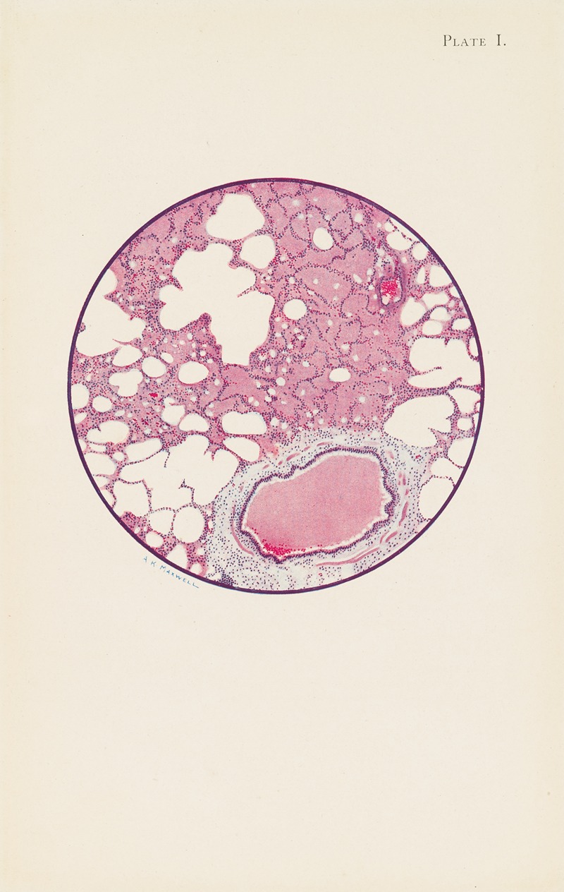 A. Kirkpatrick Maxwell - Plate I. Microscopic section of human lung from phosgene shell poisoning. Death at the nineteenth hour after gassing