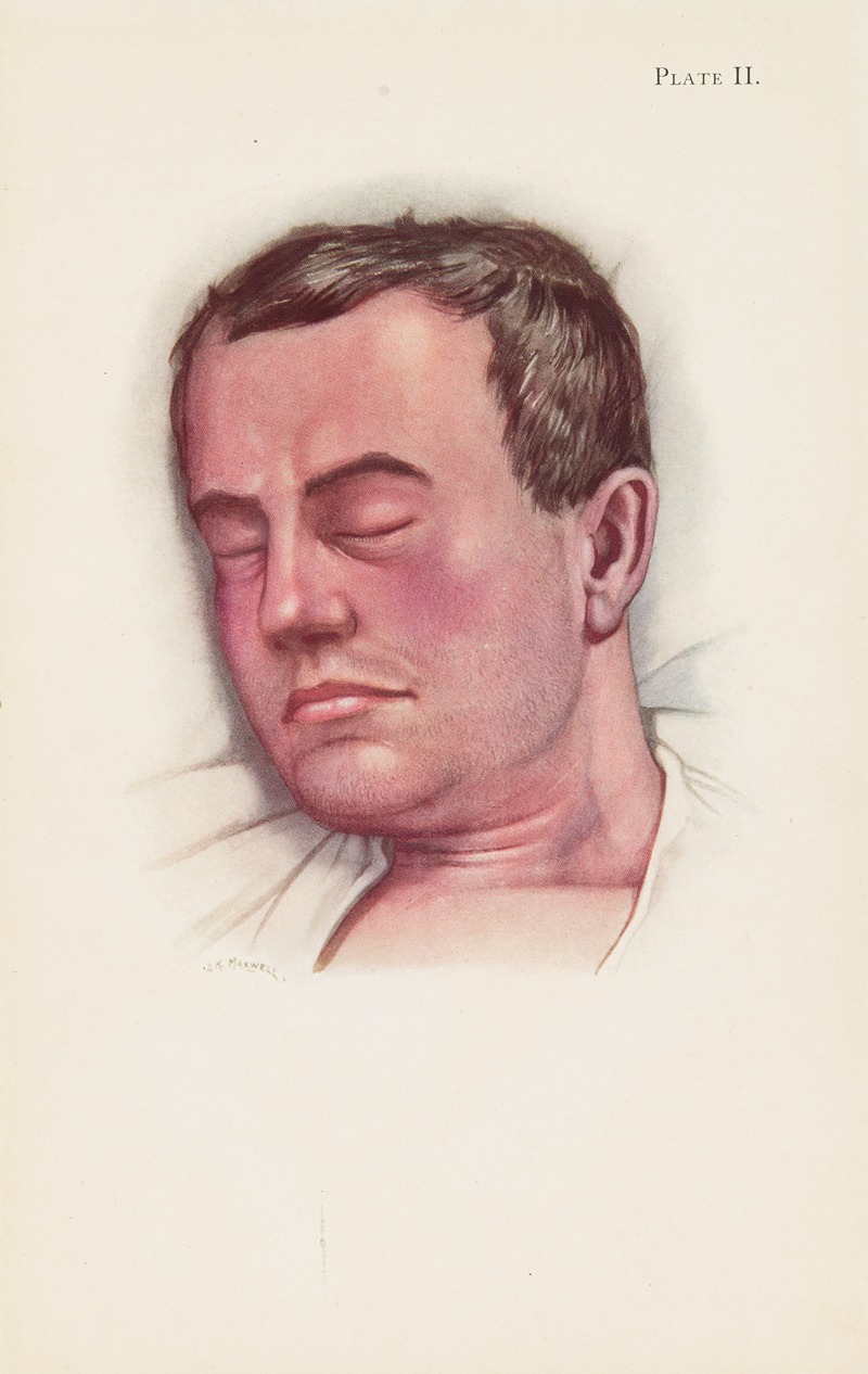 A. Kirkpatrick Maxwell - Plate II. Blue type of asphyxia from phosgene poisoning, with intense venous congestion