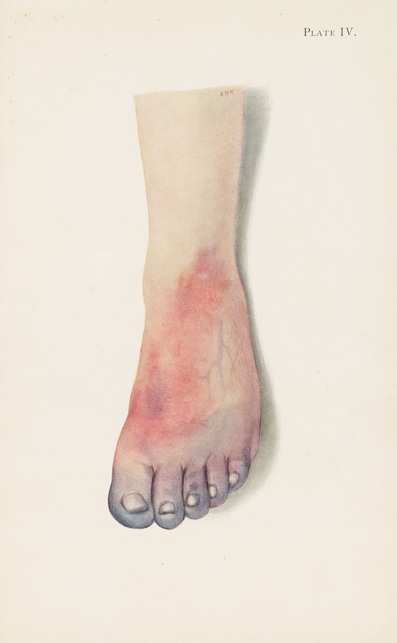 A. Kirkpatrick Maxwell - Plate IV. Gangrene of foot caused by vascular thrombosis from chlorine poisoning