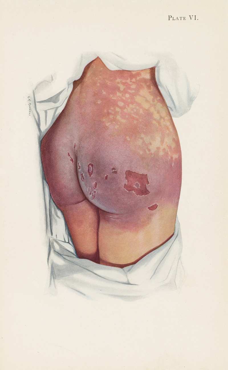 A. Kirkpatrick Maxwell - Plate VI. Blistering of buttocks by mustard gas