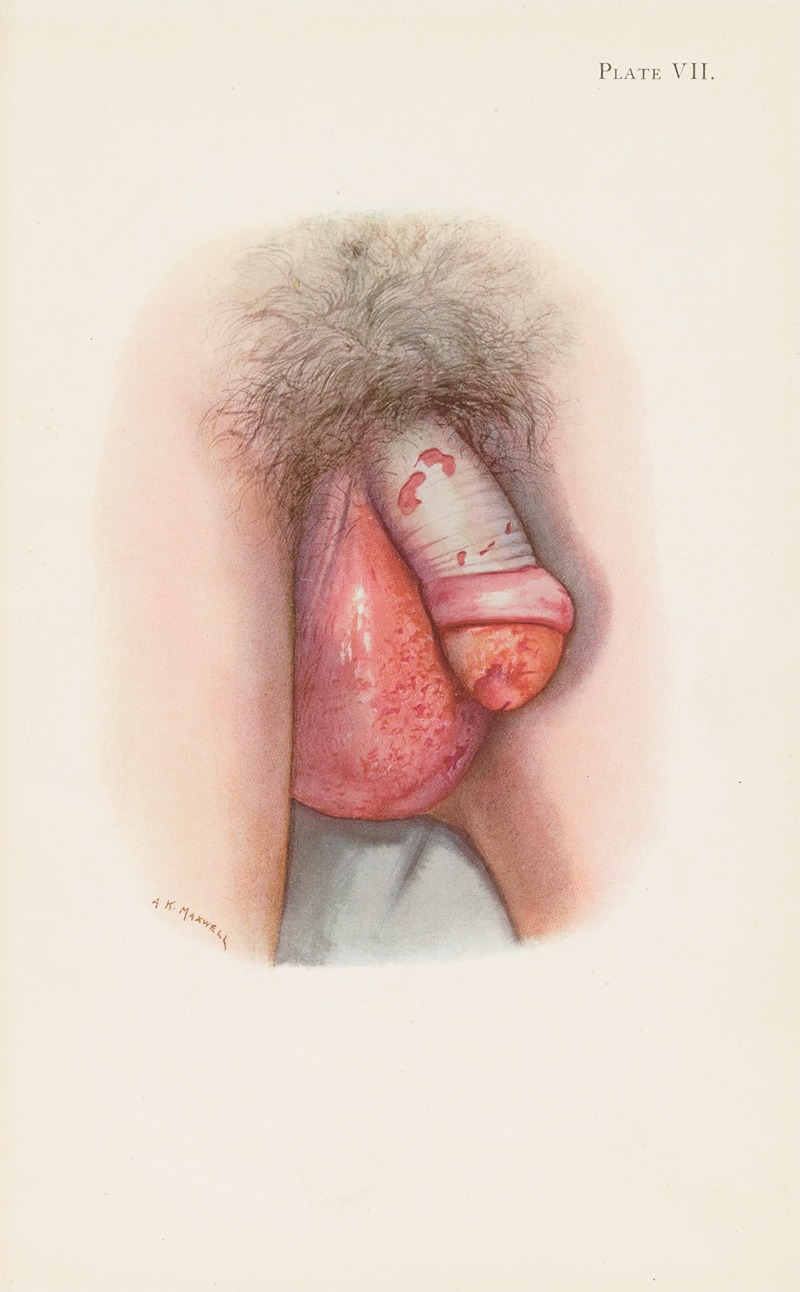 A. Kirkpatrick Maxwell - Plate VII. Burning of scrotum and penis by mustard gas