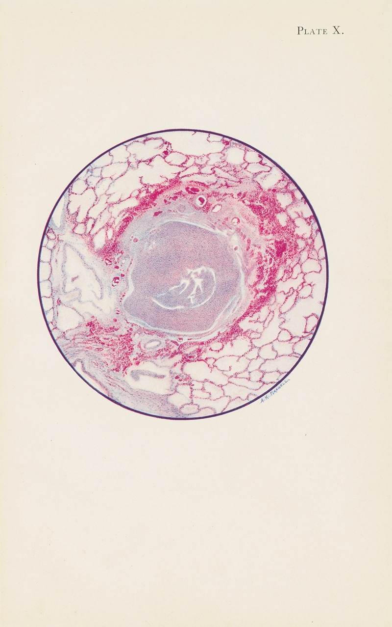 A. Kirkpatrick Maxwell - Plate X. Microscopic section of human lung from mustard gas poisoning, with death at end of second day (40 hours)